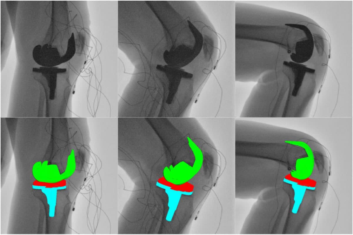Figure: (Top) fluoroscopic image sequence for deep knee bend at full extension, 60 ° of flexion, and maximum flexion. (Bottom) The same image sequence with the respective computer-aided design models overlayed, extracting in vivo kinematics